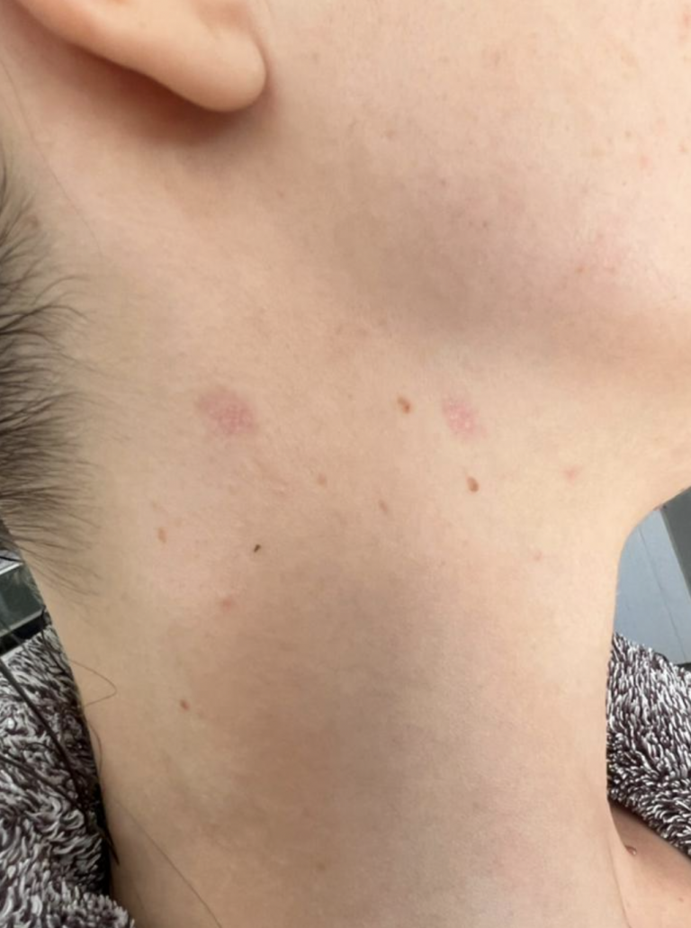 After Ultra Pulse C02 Laser