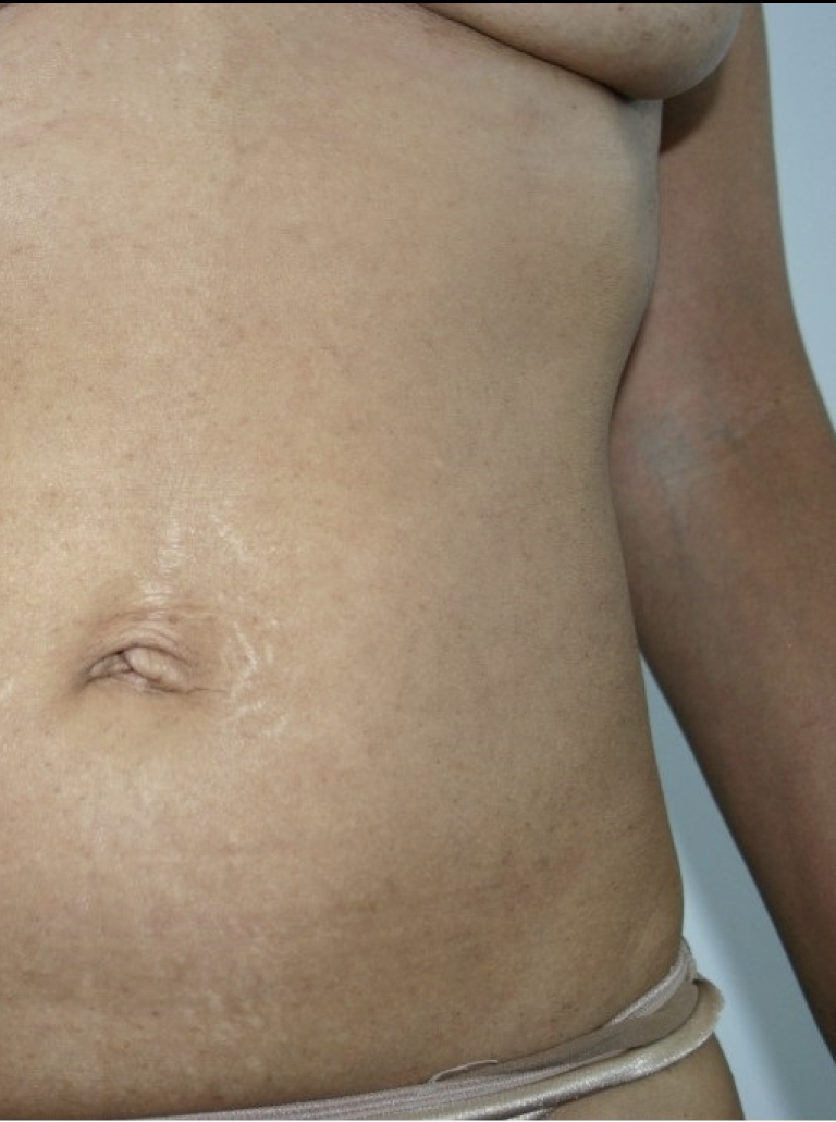 After Ultra Pulse C02 Laser